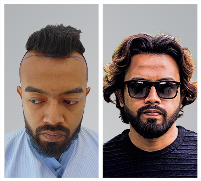kolkata hair transplant clinic